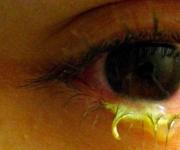 Конъюнктивит: почему краснеют глаза и как их лечить