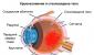 Кровоизлияние в глазное яблоко лечение