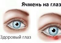 Причины появления ячменя на глазу и лечение
