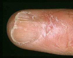 Диагностика здоровья по ногтям рук