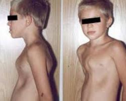 Keeled and funnel-shaped deformities of the chest in a child: causes, treatment without surgery and massage