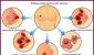 Malignant neoplasms of the breast