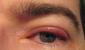 Воспаление глаз – причины, чем промывать и лечить воспаления глаз