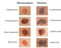 Hogyan lehet megkülönböztetni a melanoma szokásos anyajegyeket - BorisK