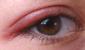 Inflamația pleoapelor superioare și inferioare ale ochiului - tratament