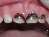 A fogszuvasodás a fogszuvasodásban szenvedő gyermekeknél: a módszer előnyei és alternatívái