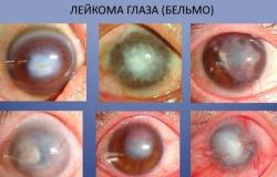 Bolest očí: příznaky, příčiny, účinná léčba