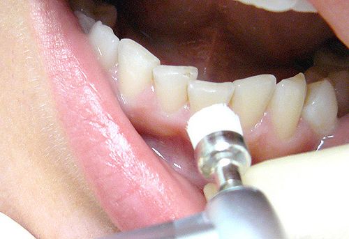 A fogszabályozó és a fogak eltávolítása: szükség van vagy sem?