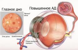 Angiopatie retiniană - tipuri, cauze, simptome, metode de diagnostic și tratament Creșterea presiunii craniene la o femeie însărcinată, angiopatie retiniană