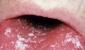 Λοίμωξη από τον ιό HIV στο στόμα: σημεία, αιτίες και πρόληψη Συμπτώματα HIV σε γυναίκες Στοματικά έλκη