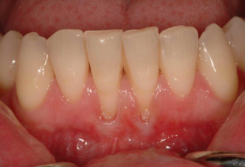 Mi a teendő, ha a fogak nyaka csupasz - a leghatékonyabb kezelési mód