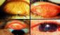 Inflamația ochiului - tipuri, simptome, tratament