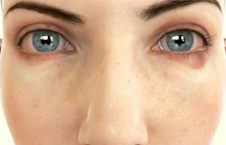 Воспаление глаз - чем промывать и лечить?