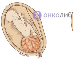 Teratoma - types and causes of occurrence Teratoma in the chest