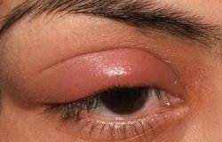 Umflarea pleoapei superioare a unui ochi - cauze și tratament