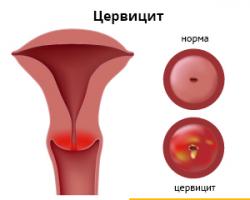 Jak léčit genitální infekce?