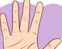 Varianta brahidactiliei: falange scurtă a degetului mare Anatomia degetului mare 1 falangă