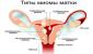Jaká velikost fibroidů je normou a u které operace je indikována