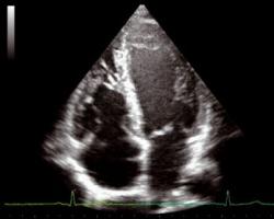 Rozluštění ultrazvukového skenu srdce Rozměry lp