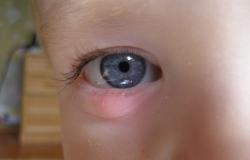 Πώς να θεραπεύσετε το λάκκο κάτω από τα μάτια ενός παιδιού
