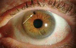 Jaké jsou příčiny černých teček v očích a jaká je léčba?