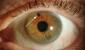 Mi okozza a mitesszereket a szemekben és mi a kezelés?