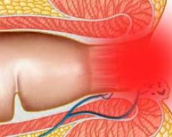 Prolapse of the rectum (rectal prolapse)