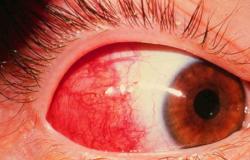 Sângerare în ochi - cauze și tratament