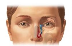 Inflamația ductului lacrimal: cauze, simptome, metode de tratament