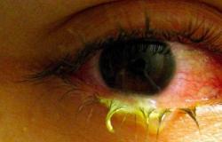 Konjunktivitida: proč oči zčervenají a jak je léčit