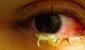 Konjunktivitida: proč oči zčervenají a jak je léčit