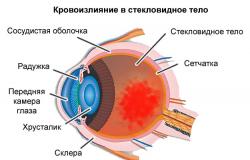 Krvácanie pri liečbe očnej gule