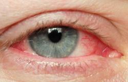 Zašto se pojavljuju crvene oči, šta učiniti ako imate takve probleme