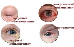 Oční kapky na konjunktivitidu