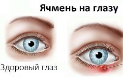 Przyczyny jęczmienia na oku i leczenie