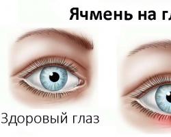 Cauzele orzului pe ochi și tratament