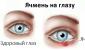Причины появления ячменя на глазу и лечение