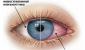 Cechy wirusowej choroby oczu