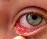 目の上の大麦 - 治療と予防